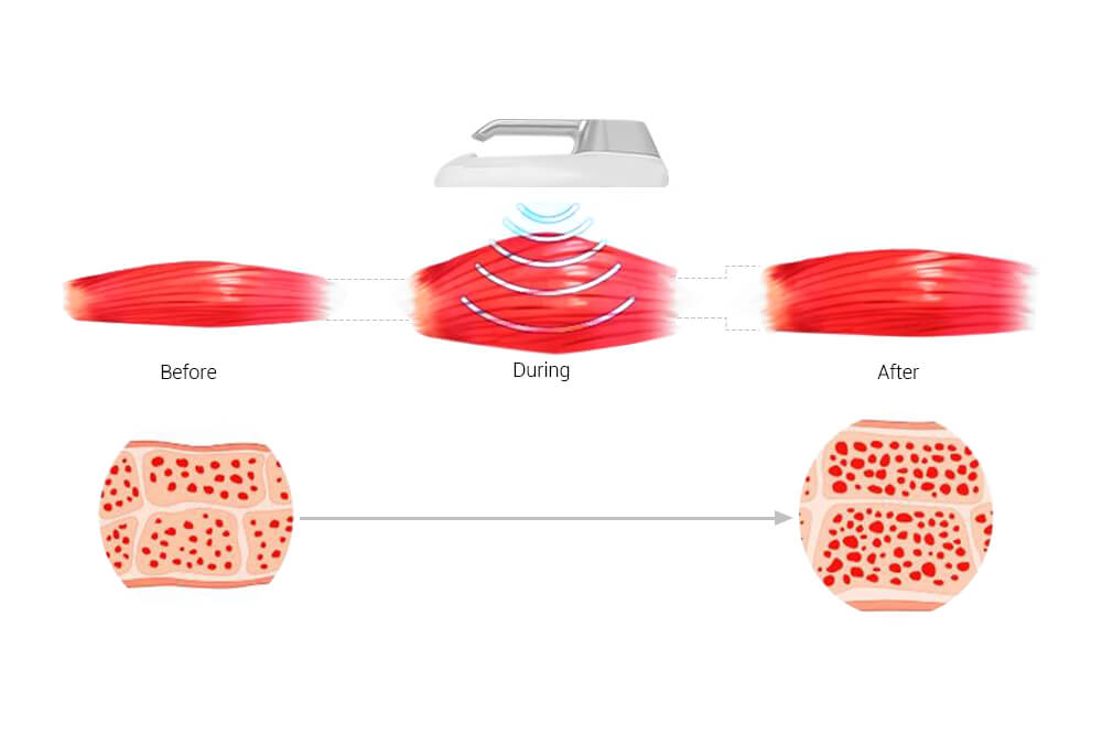 Ems slimming machine GN232 5