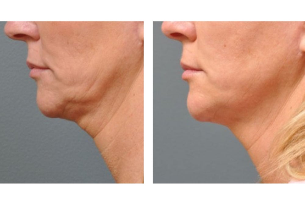 تقنية GN250 HIFU قبل وبعد استخدام GN250 HIFU3