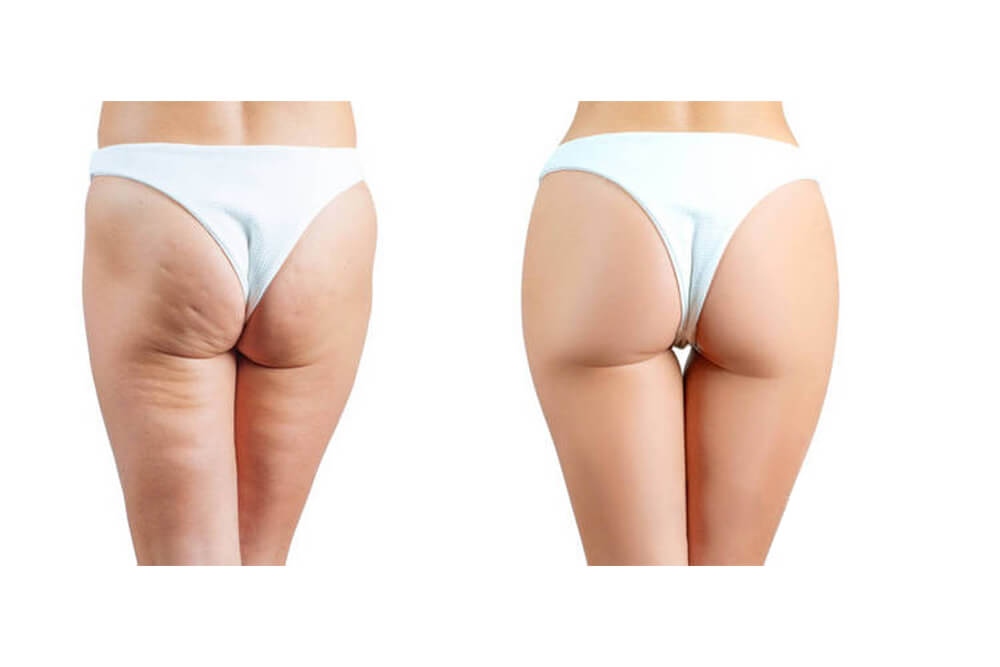 машина для поднятия ягодиц и груди FX051D 11