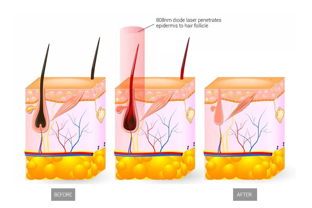 épilateur à diodes en086 8
