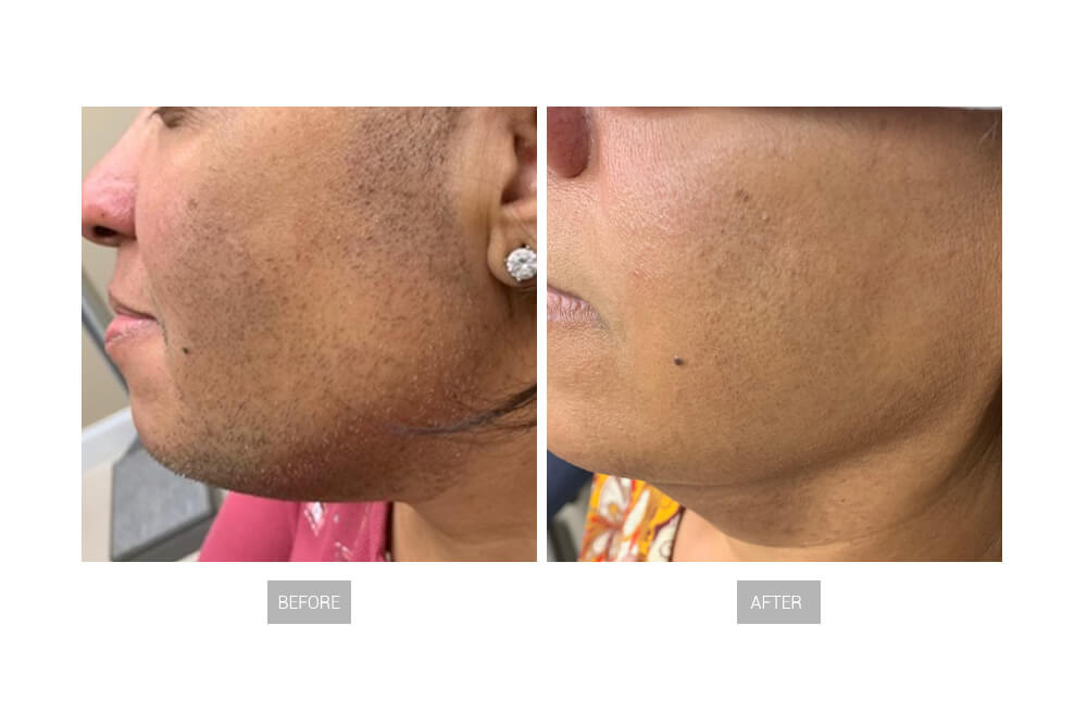 épilation avant et après 1