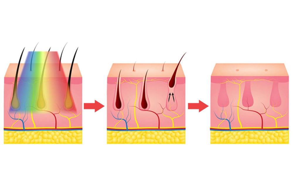 épilateur shr en087 6