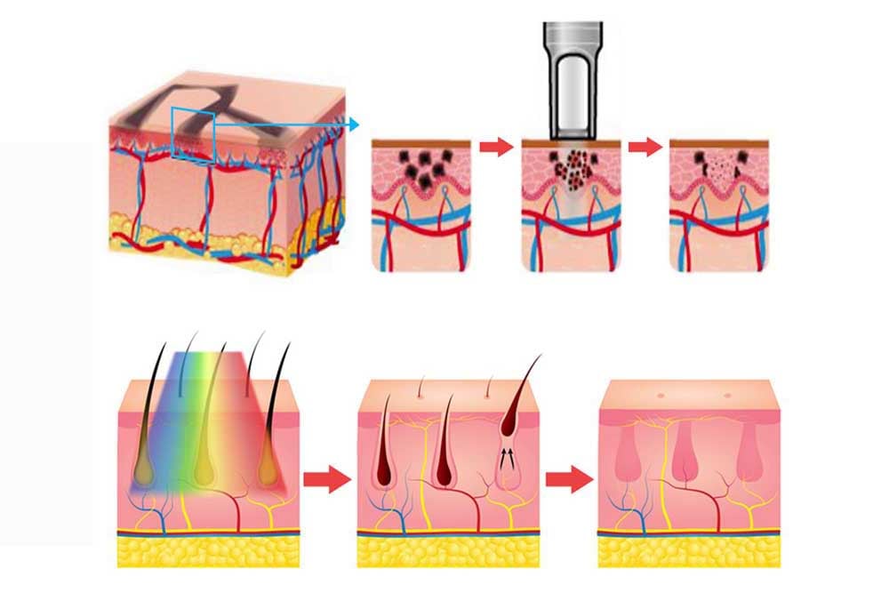 문신 색소 제거 기계 EN100 9 1