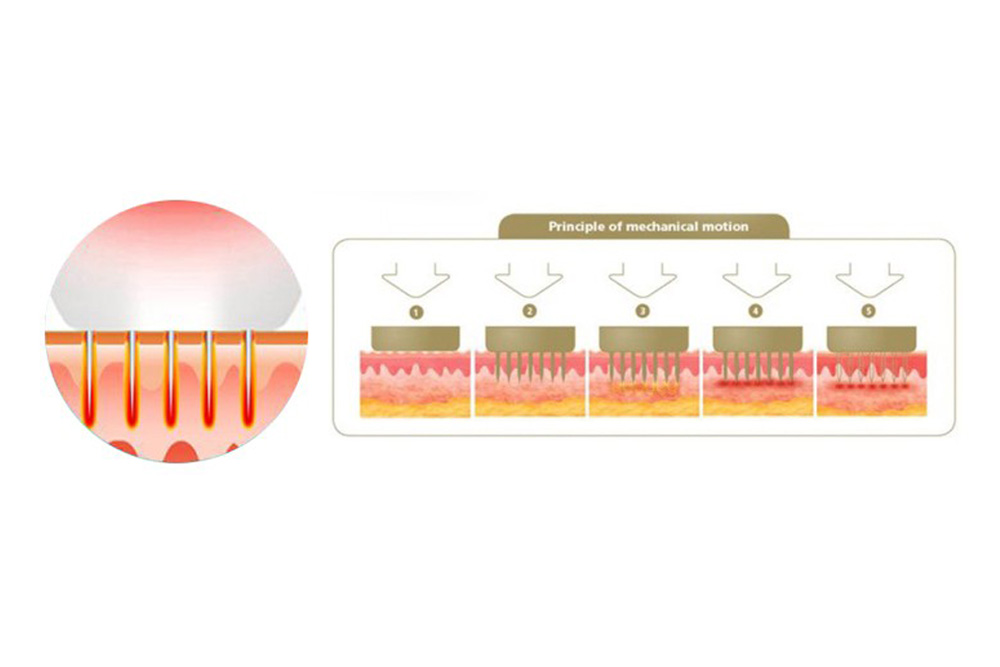 Machine à micro-aiguilles RF pour le visage LB185（3）
