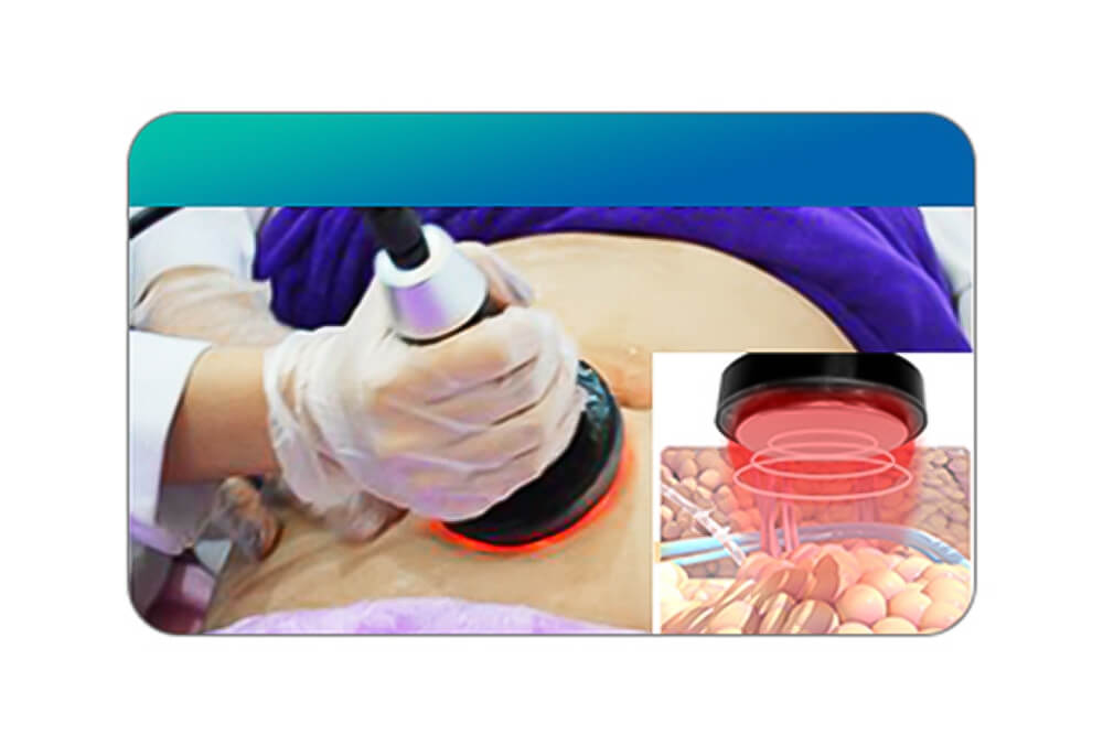 지방 냉동 슬리밍 기계 JF671 8