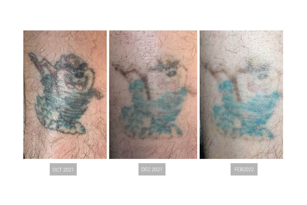 détatouage avant et après 2