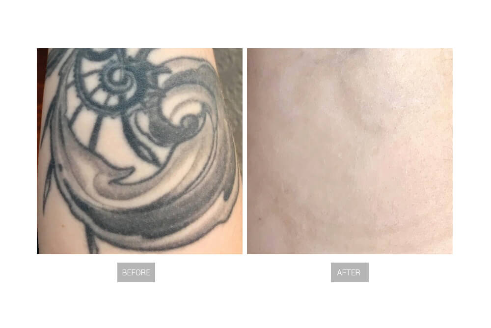 Tattooentfernung vor und nach 3