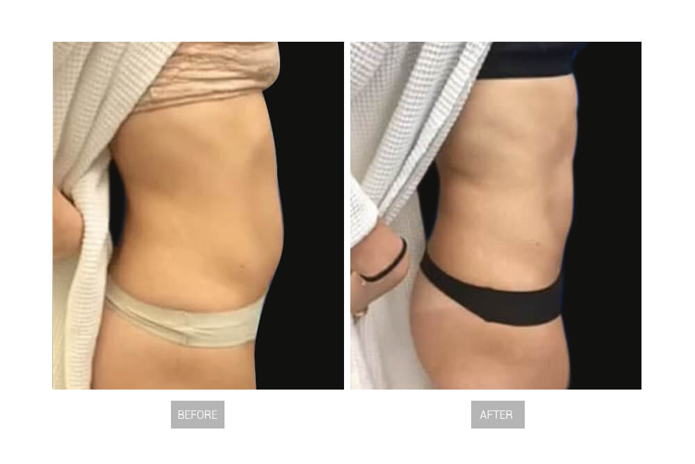 body sculpting machine before and after 1