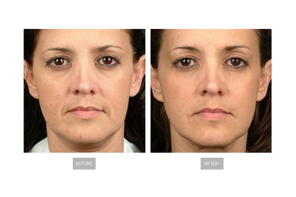 hifu beauty machine 7