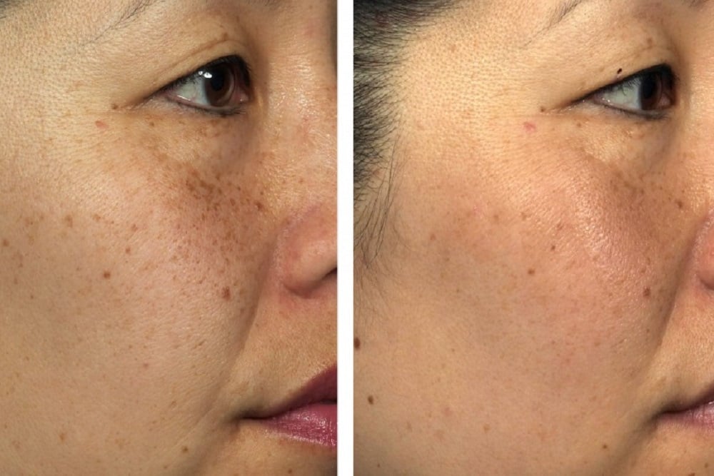 Micro Electric 7-Color LED Skin Mask - konmison