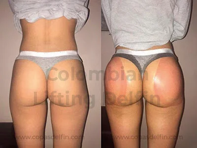 fesses avant et après