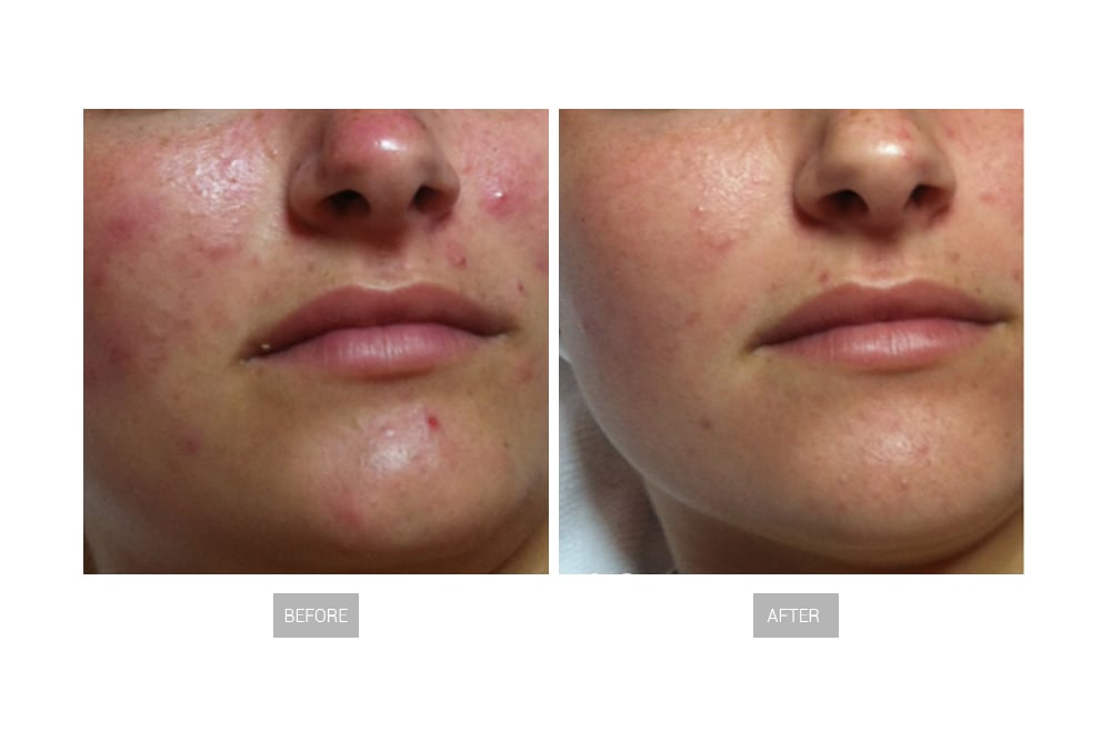 LB594 гидра-дермабразия1 2