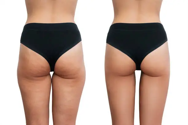 ultrasone cavitatie voor en na 4