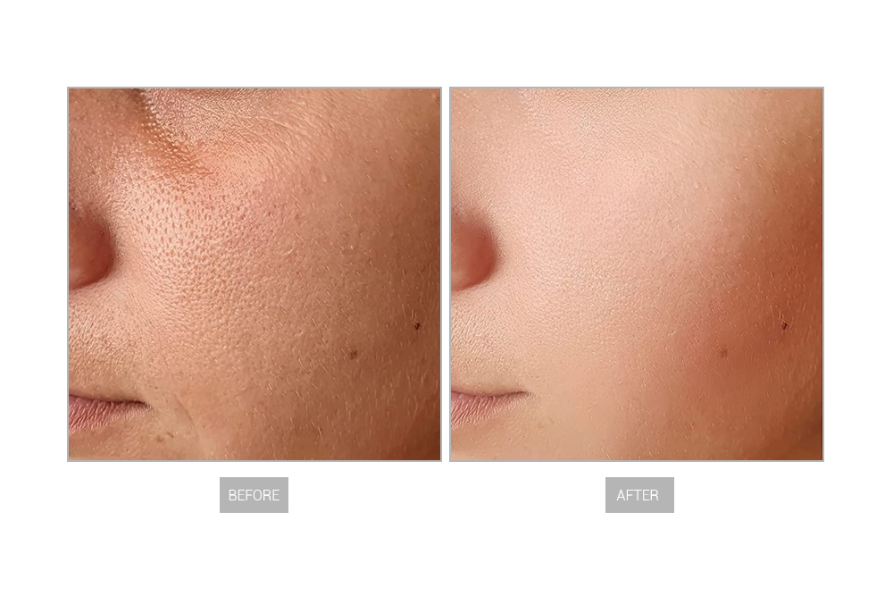 EN109 레이저 문신 제거15