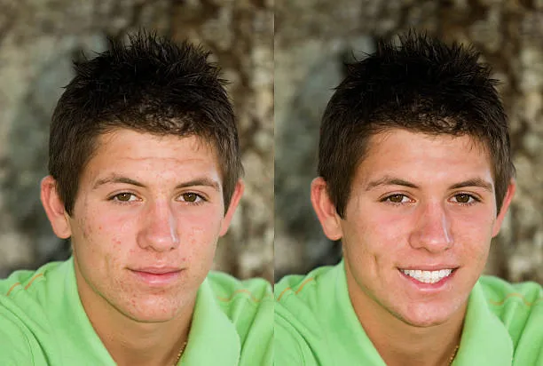 hydrafacial avant et après