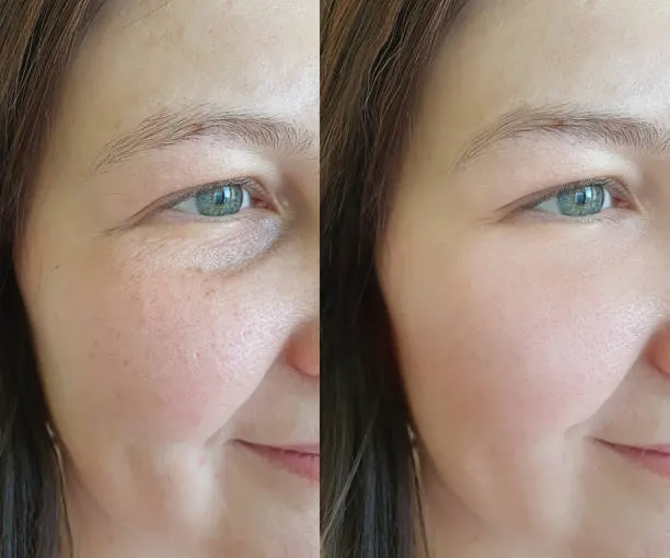 hydrafacial avant et après