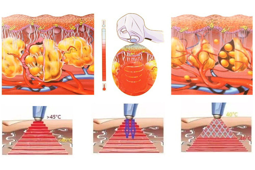 JF240 RF 지방 제거6