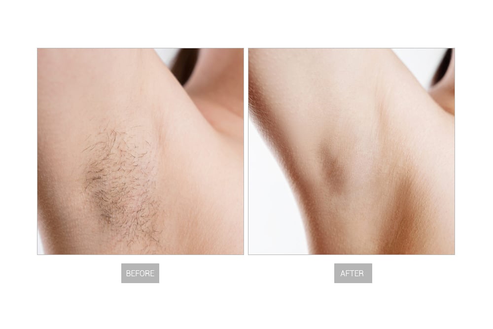 EN127 laser hair remove7