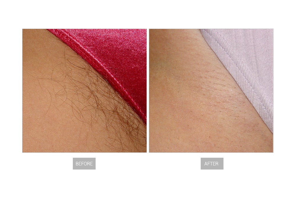 EN127 laser hair remove8