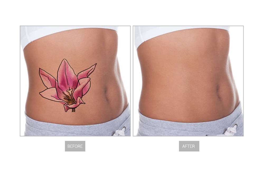 Laser picoseconde GN6407