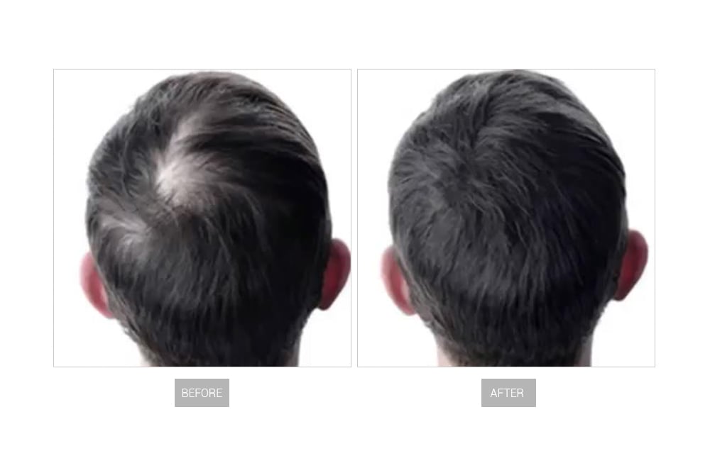 GN272レーザー発毛13