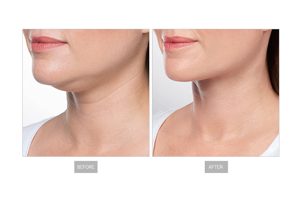 وجه GN522A PE GN522A8