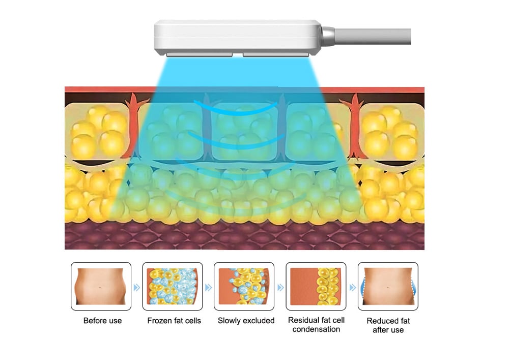 JF848B EMS cryo slim 6