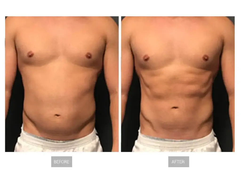 EMSculpt vs EMSculpt Neo