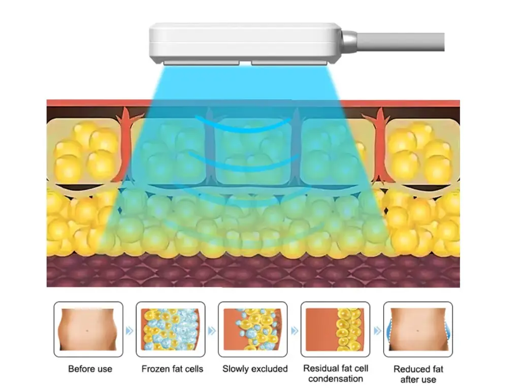 cryolipolysis faq3
