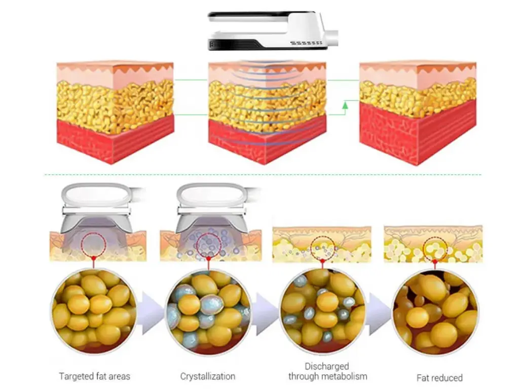 trusculpt-vs-emsculpt