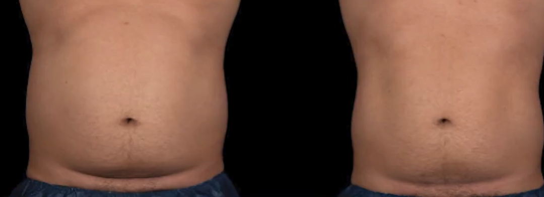 trusculpt-vs-emsculpt2