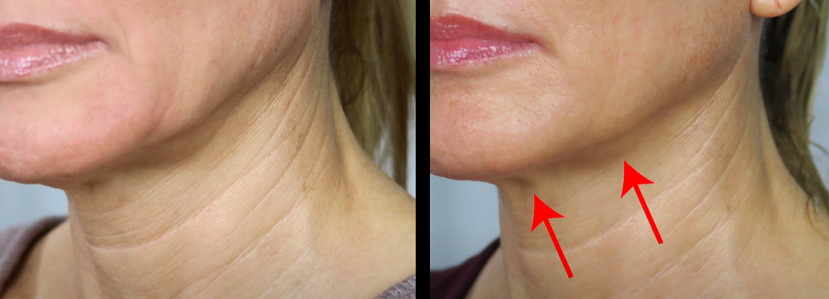 Ultherapy Results