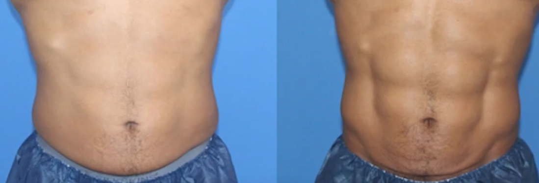 trusculpt-vs-emsculpt3