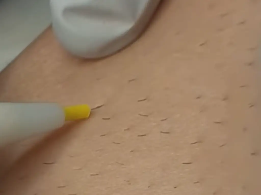 laser-hair-removal-vs-electrolysis