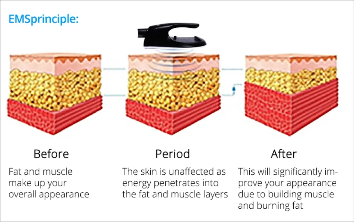 emtone vs emsculpt 4