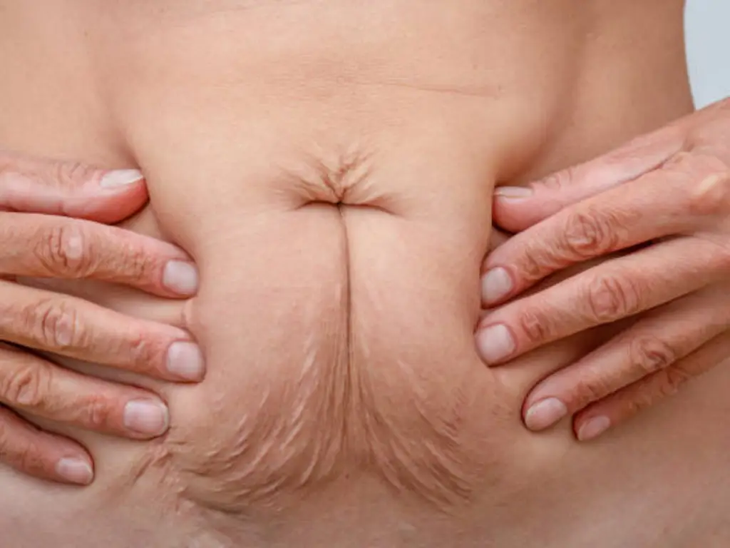 loose skin