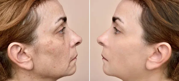 microneedling prima e dopo