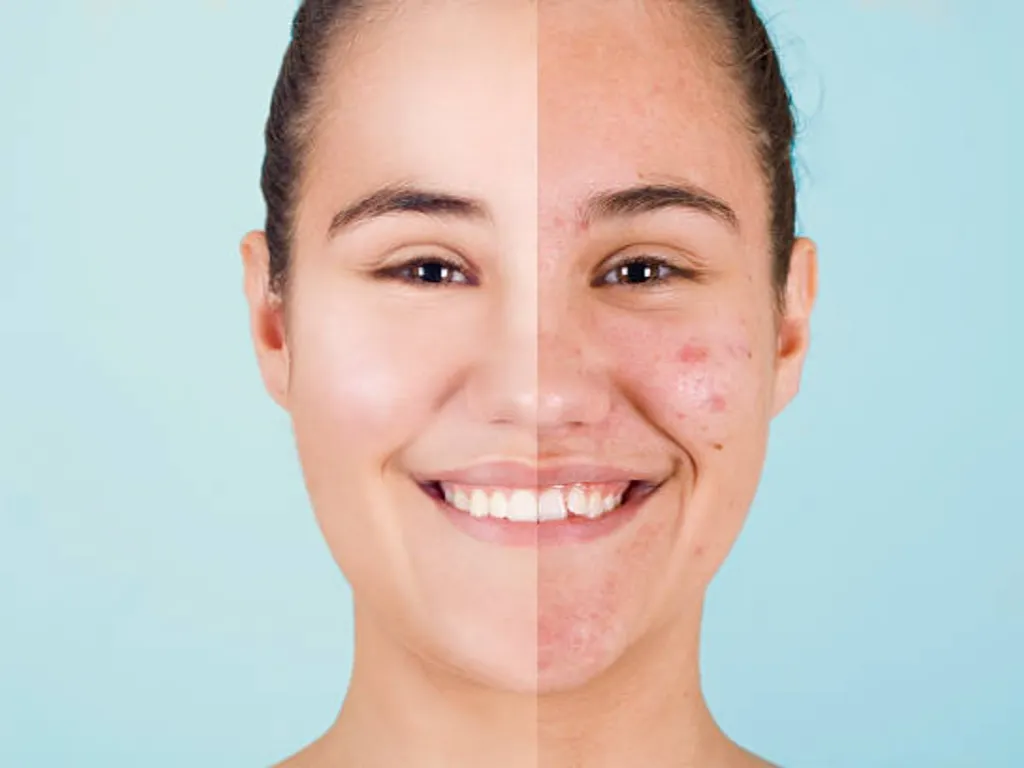 gold microneedling before and after 1 1