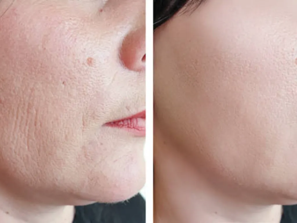 gold microneedling before and after 2 1