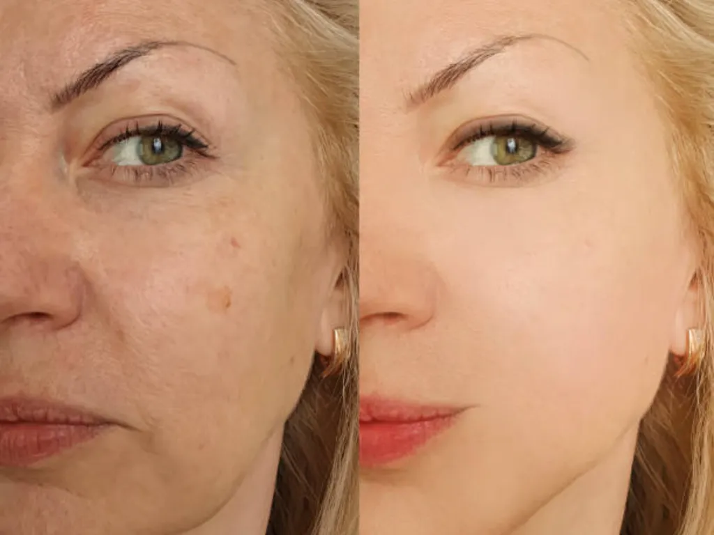 gold microneedling before and after 4 1