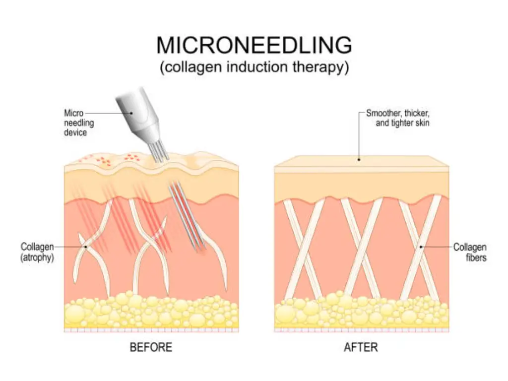 Combien de fois le microneedling doit-il être pratiqué ?