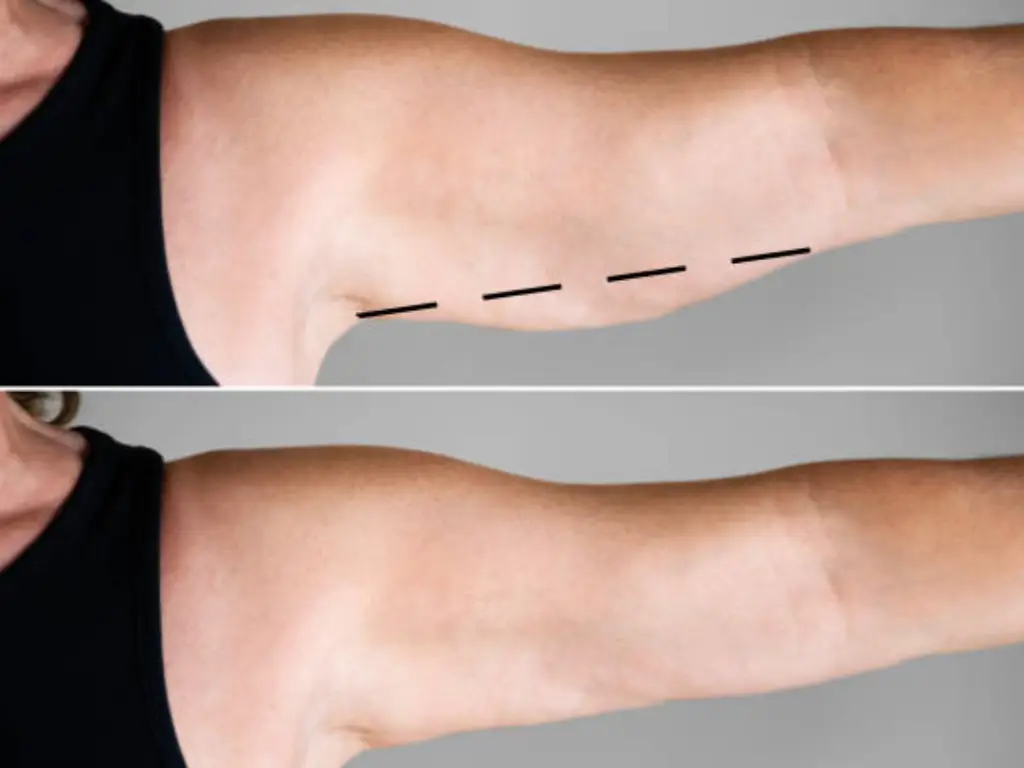 emsculpt neo before and after