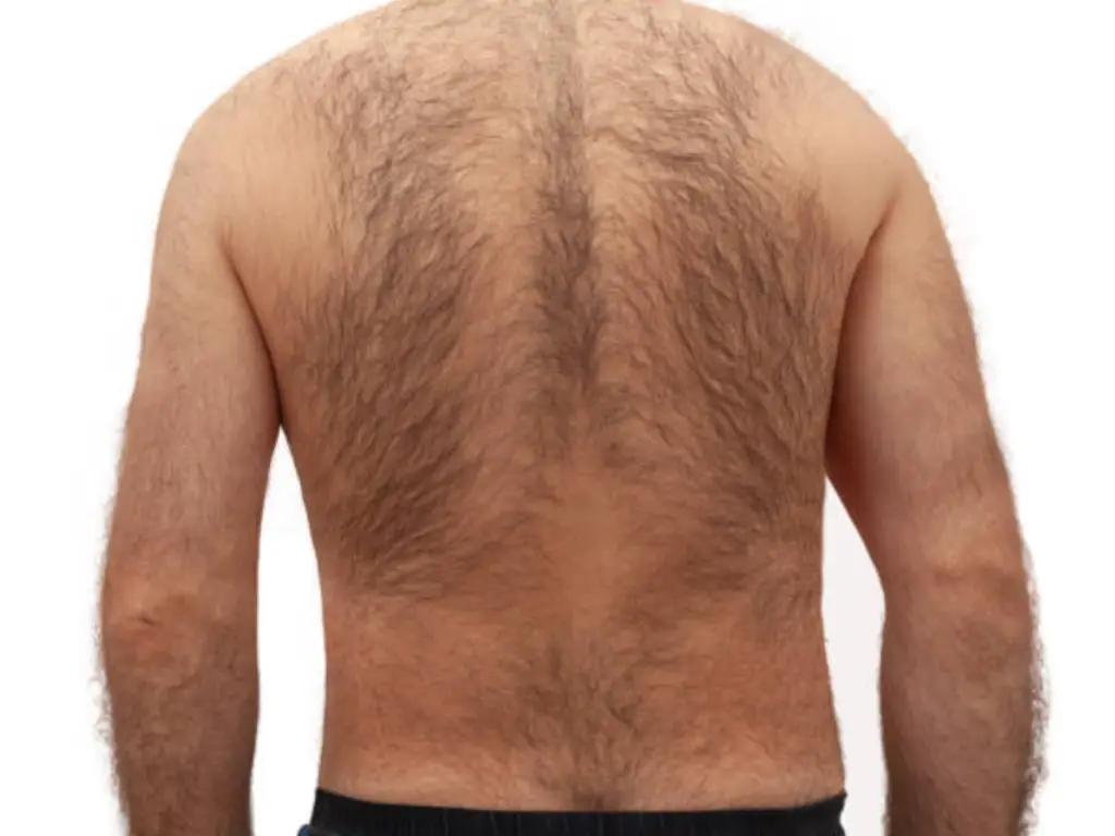 laser back hair removal cost