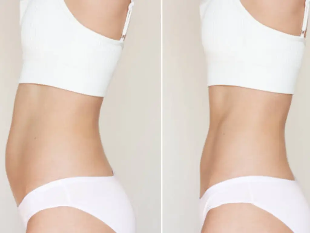 RX Stringimento della pelle prima e dopo