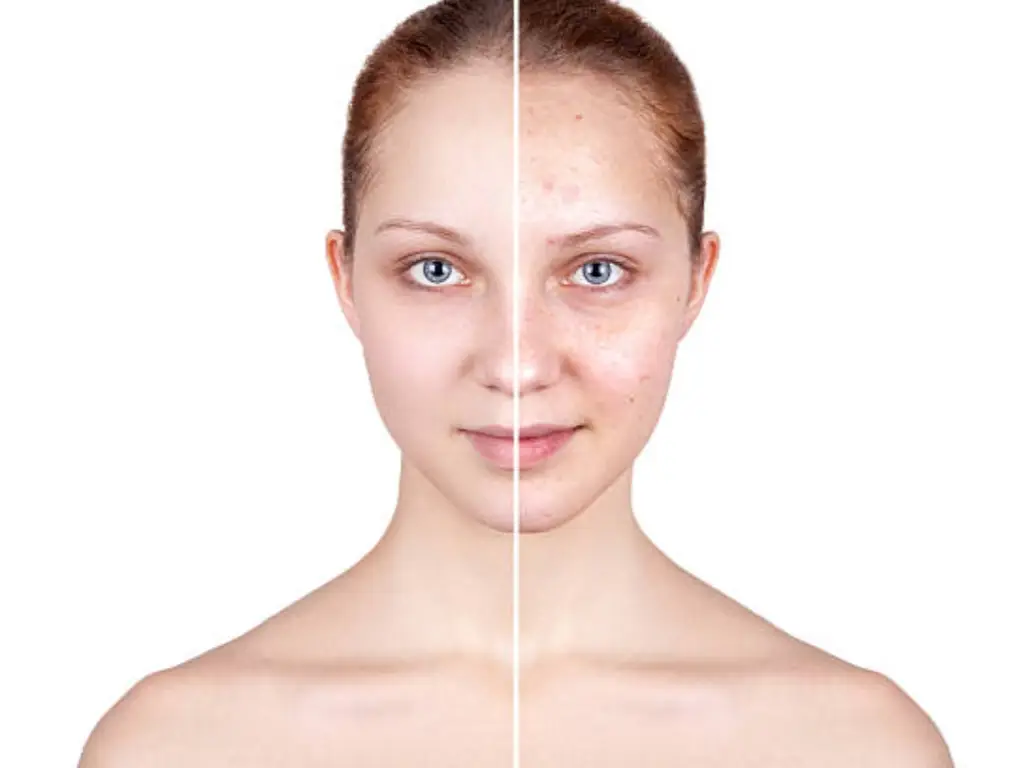 hydrafacial avant et après les pores