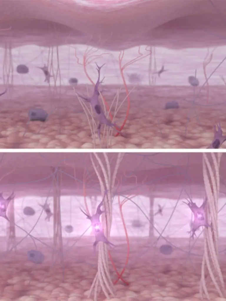 Qu'est-ce que le raffermissement de la peau par radiofréquence ?