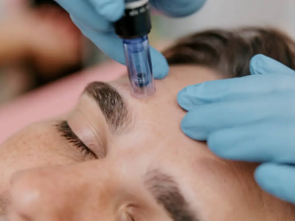 rf microneedling before and after 1 treatment