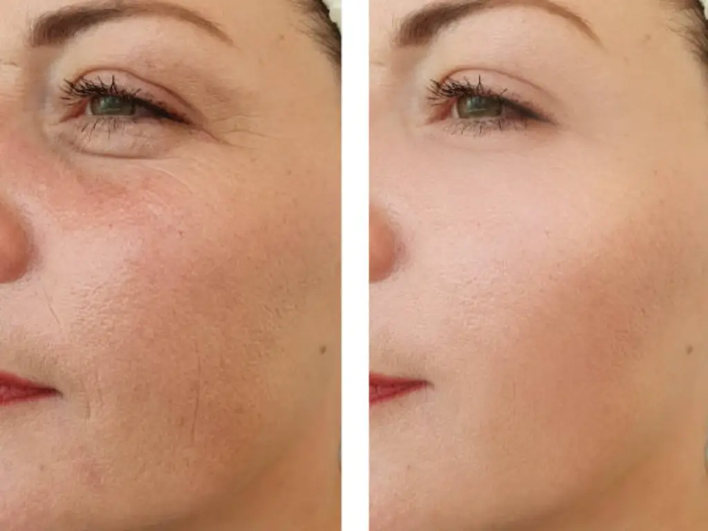 rf microneedling before and after 3 treatments
