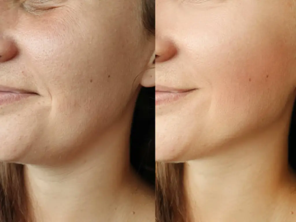 rf microneedling before and after 3 treatments