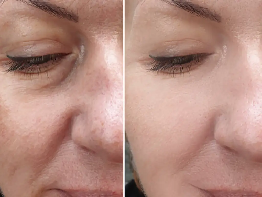 rf microneedling before and after 3 treatments